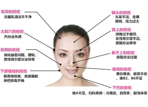 原來(lái)這些因素會(huì)導(dǎo)致長(zhǎng)痘痘！你知道嗎?
